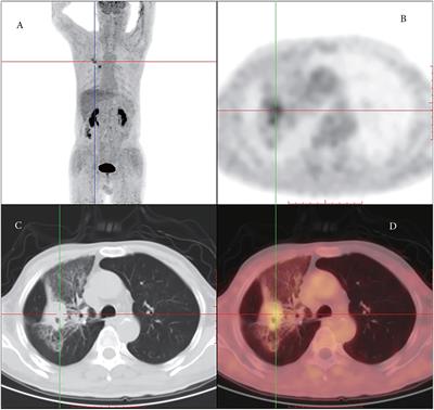 Case report: Rare intrapulmonary malignant mesothelioma complicated with myositis